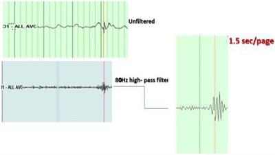 High-Frequency Oscillations on Interictal Epileptiform Discharges in Routinely Acquired Scalp EEG: Can It Be Used as a Prognostic Marker?
